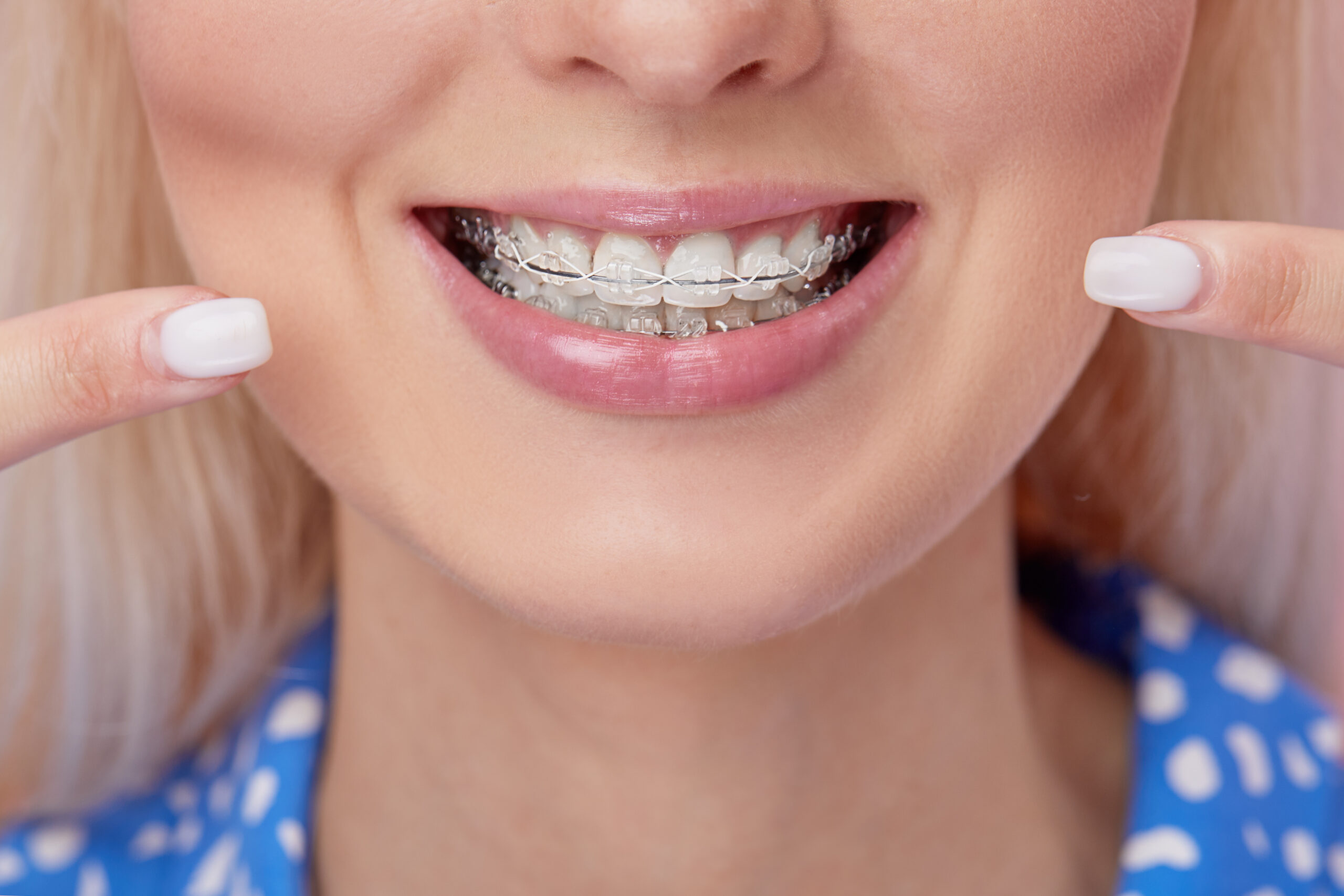 Clear Braces vs. Invisalign: Which Option Is Right for Your Smile?